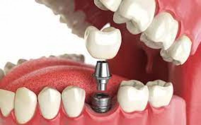 Имплантация зубов: протез или мост?